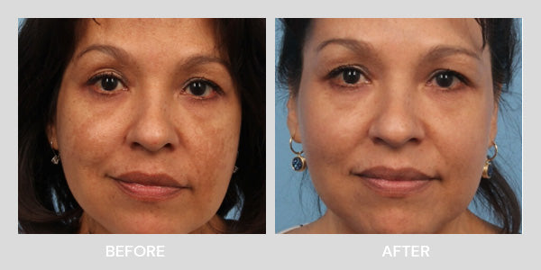 Kaiser Method melasma before and after
